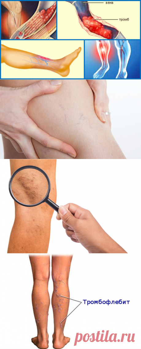 МКБ-10. Тромбоз вен нижних конечностей