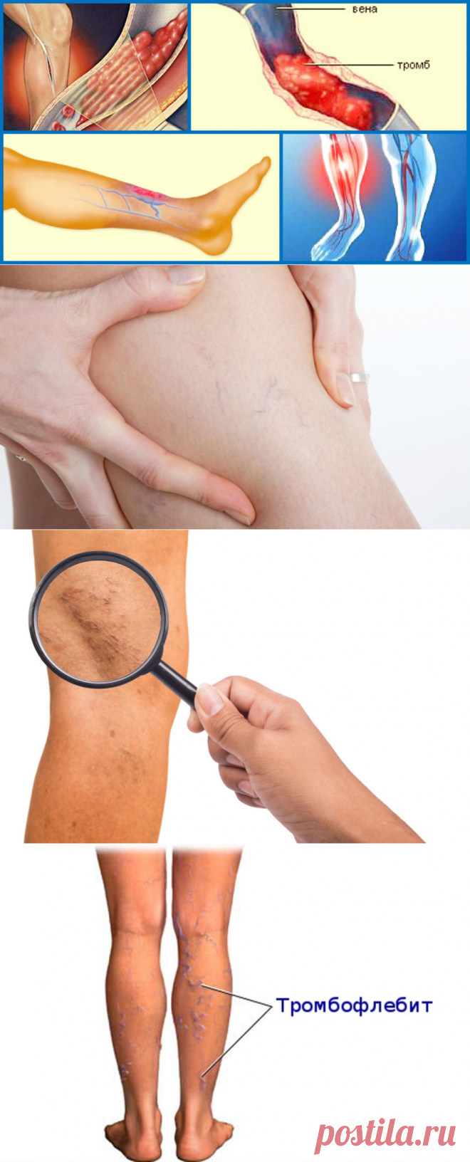 МКБ-10. Тромбоз вен нижних конечностей