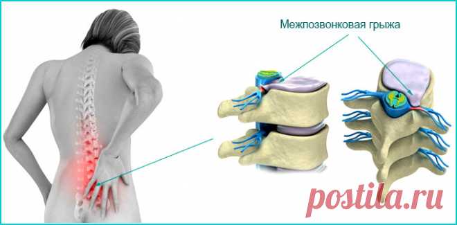 Простые упражнения для здорового позвоночника. Межпозвоночная грыжа