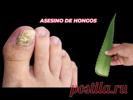 ¡ASESINO!🔥de hongos en las uñas, ¡INMEDIATAMENTE! el mejor remedio natural 🌿