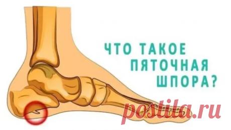 О лечении пяточной шпоры я уже не раз писал: в народной медицине существуют несколько способов  ее лечения.
Вот один из них.
Возьмите пузырек валерьянки и покрошите в него мелко порезанный красный жгучий перец.
Полученный состав поставьте настаиваться на 10 дней.
Затем, состав процедите через марлю и делайте с ним компресс (строго на пятку).
Будет немного жечь, но придется потерпеть.
Зато от шпоры избавитесь.
ПЕРЕД ПРИМЕНЕНИЕМ ЛЮБОГО ПРЕПАРАТА, СРЕДСТВА ИЛИ МЕТОДА ЛЕЧЕНИЯ,...