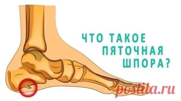 О лечении пяточной шпоры я уже не раз писал: в народной медицине существуют несколько способов  ее лечения.
Вот один из них.
Возьмите пузырек валерьянки и покрошите в него мелко порезанный красный жгучий перец.
Полученный состав поставьте настаиваться на 10 дней.
Затем, состав процедите через марлю и делайте с ним компресс (строго на пятку).
Будет немного жечь, но придется потерпеть.
Зато от шпоры избавитесь.
ПЕРЕД ПРИМЕНЕНИЕМ ЛЮБОГО ПРЕПАРАТА, СРЕДСТВА ИЛИ МЕТОДА ЛЕЧЕНИЯ,...