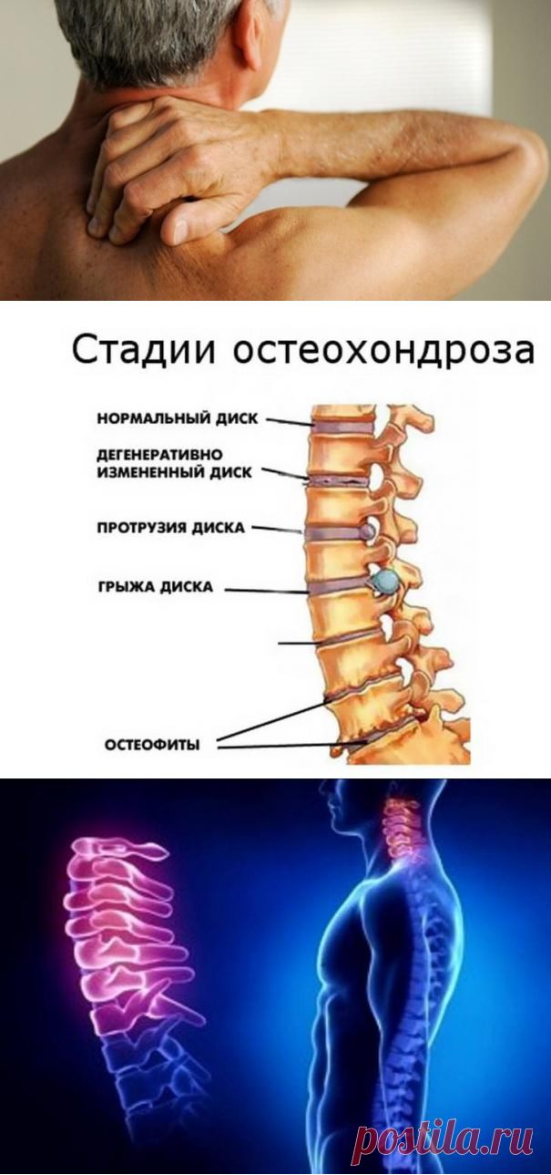 Остеохондроз — расплата за непонимание собственного организма