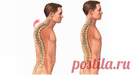 Грудной кифоз: это не просто плохая осанка! Это очень опасно! - Упражнения и похудение В статье объясняется, как определить ЧГК, выявляются некоторые наиболее распространённые причины, обсуждаются потенциальные симптомы и предлагаются способы решения проблемы. Чрезмерный грудной кифоз (ЧГК) – непропорционально большое округление назад или изгиб средней и верхней части спины, также известный, как грудной отдел позвоночника. ЧГК является очень распространённым скелетно-мышеч...