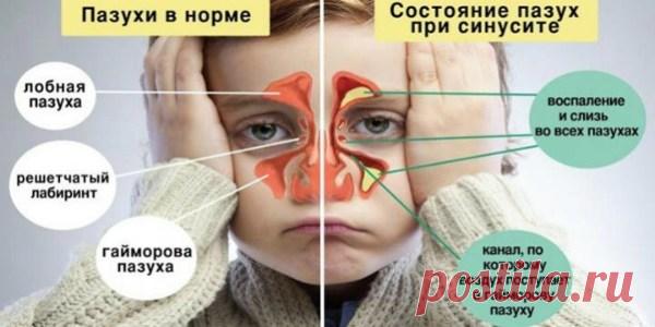 4 мощных средства против СИНУСИТА + простой трюк, который очистит пазухи всего за 20 секунд, смотрите!