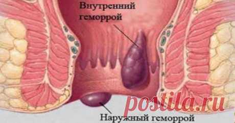 Она больше не боится ГЕМОРРОЯ! Смотри, 10 самых эффективных средств от свай.   Не дай геморрою ни единого шанса! Смотри, как избавиться от него быстро! Геморрой беспокоит целых 75% людей в какой-то момент в их жизни. Он