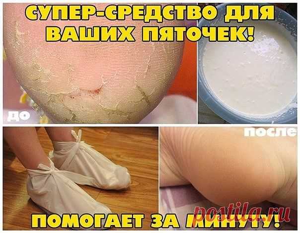Пяточки