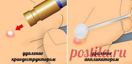 Удаление бородавок жидким азотом: как происходит лечение