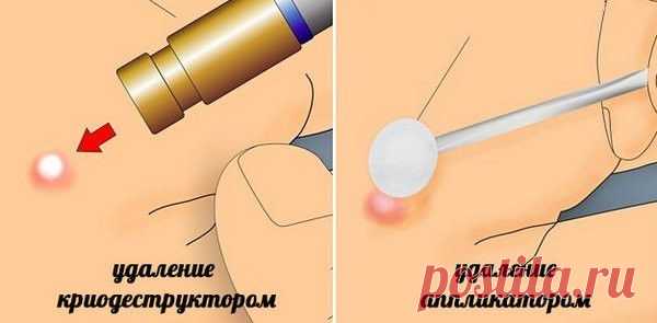 Удаление бородавок жидким азотом: как происходит лечение