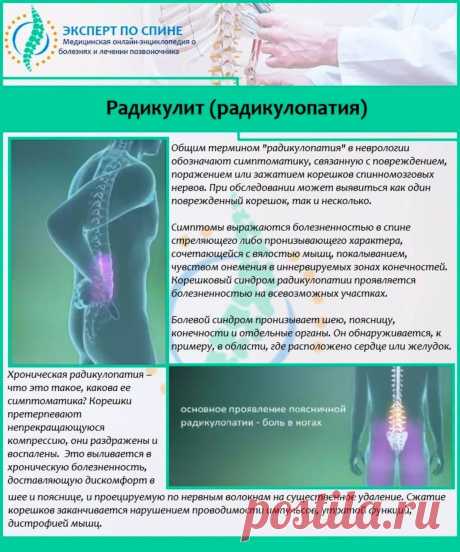 Радикулит (радикулопатия)
