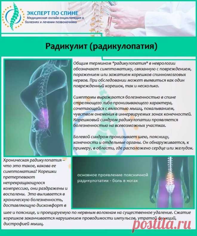 Радикулит (радикулопатия)