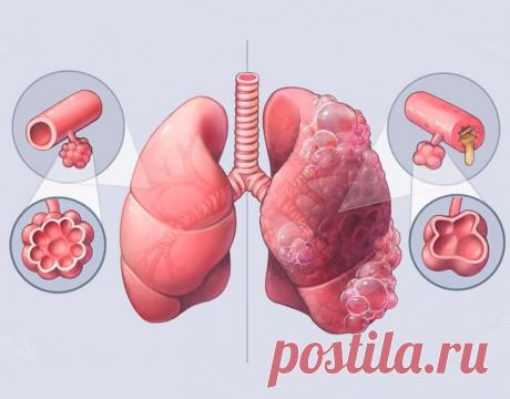 Каковы симптомы ХОБЛ? ХОБЛ (хроническая обструктивная болезнь легких) — это прогрессирующее заболевание, которое характеризуется устойчивым ограничением воздушного потока в легких. Его симптомы часто развиваются медленно и усугубляются со временем, особенно если продолжается воздействие вредных факторов (например, курение). По каким признакам можно распознать это заболевание на ранней стадии? ...