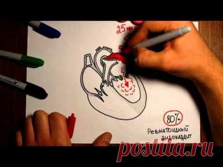 Митральный стеноз. Гемодинамика при пороках сердца. - "Просто о сложном" -