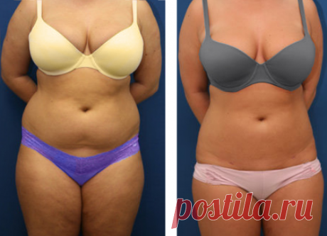 Я убрала дряблую кожу и висячий жир на животе, благодаря бабушкиному отвару за 20 дней | Решила похудеть | Яндекс Дзен