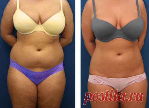 Я убрала дряблую кожу и висячий жир на животе, благодаря бабушкиному отвару за 20 дней | Решила похудеть | Яндекс Дзен