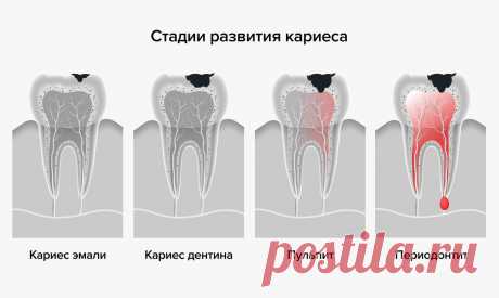 Почему болит целый зуб
Здоровый зуб имеет внутри дентинные канальца, на протяжении твердых тканей коронки. Эти канальца являются сигнальными путями, входящими в центр зуба нервно-сосудистый пучок (нерв в зубе). Любая микротрещинка на поверхности зуба или повреждение эмали зуба будет иметь отражение в этих самых дентиновых канальцах, а они в свою очередь передадут сигнал о проблеме в зубе в нерв. Вот, почему болит зуб без видимых причин