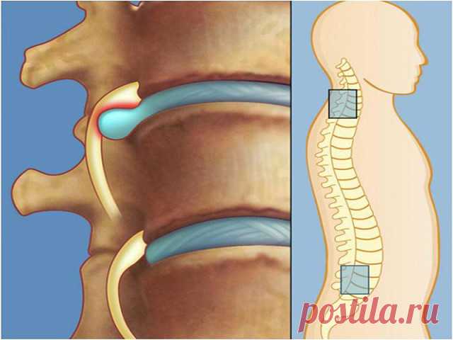 Лечение межпозвоночной грыжи без лекарств и операции: упражнения для спины от Шамиля Аляутдинова