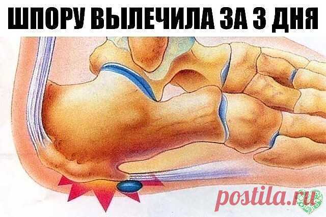 ШПОРУ ВЫЛЕЧИЛА ЗА 3 ДНЯ | OK.RU