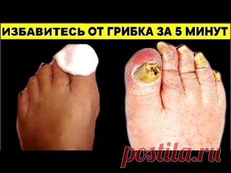 ГРИБОК НОГТЕЙ можно выгнать НАВСЕГДА за 5 минут обычным ... Это точно есть у всех дома !
