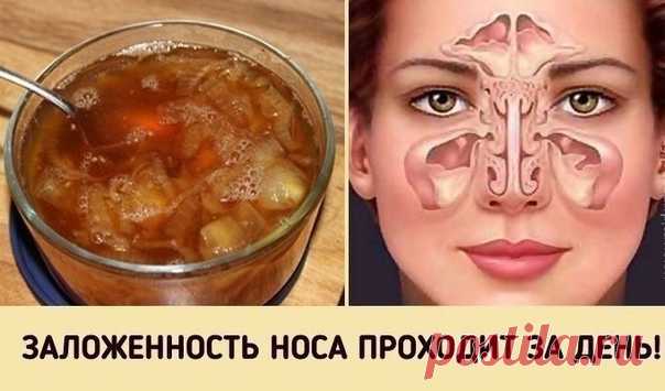 Замечательное средство от заложенного носа.
Будете свободно дышать уже на утро!

Не спешите бежать в аптеку, а лучше сначала попробуйте этот рецепт…

Oceнне-зимний период — самое время простудных заболеваний. Даже если у вас отличный иммунитет, от этого недуга никто не застрахован. Особенно, если вы много работаете с людьми и ездите в общественном транспорте.

У вас заложен нос и сложно дышать? К счастью, есть одно проверенное народное средство, которое лечит насморк за но...