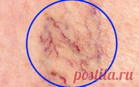 Уничтожаем «СОСУДИСТЫЕ ЗВЕЗДОЧКИ» на ногах без операций и лекарств! Некрасивые  сосудистые «звездочки» на ногах доставляют многим женщинам массу неудобств. Неэстетичность внешнего вида вздувшихся вен на ногах – это лишь верхушка айсберга. На самом деле – это серьезное заболевание, нуждающееся в своевременном диагностировании, правильном лечении, выполнении всех рекомендаций врача. В народной медицине также есть довольно эффективные и безопасные способы избавления от сосуди...