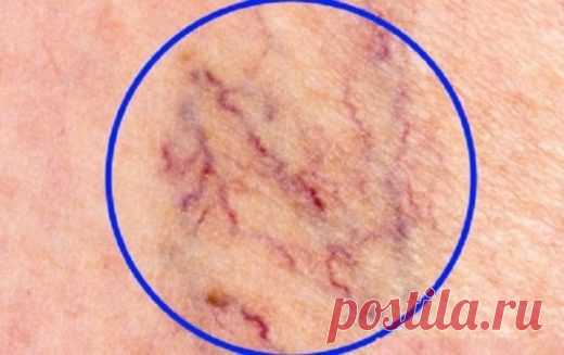 Уничтожаем «СОСУДИСТЫЕ ЗВЕЗДОЧКИ» на ногах без операций и лекарств! Некрасивые  сосудистые «звездочки» на ногах доставляют многим женщинам массу неудобств. Неэстетичность внешнего вида вздувшихся вен на ногах – это лишь верхушка айсберга. На самом деле – это серьезное заболевание, нуждающееся в своевременном диагностировании, правильном лечении, выполнении всех рекомендаций врача. В народной медицине также есть довольно эффективные и безопасные способы избавления от сосуди...