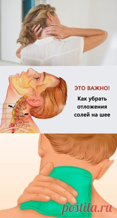 Убираю сама отложения солей на шее компрессом из 3 ингредиентов. Всё просто!