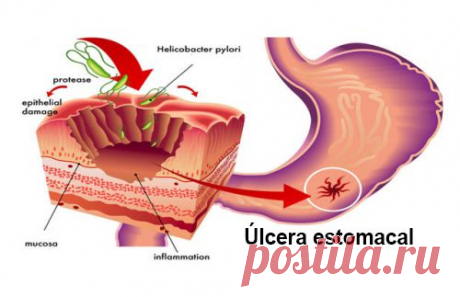 Tratamientos naturales para combatir la bacteria Helicobacter Pylori - Mejor Con Salud