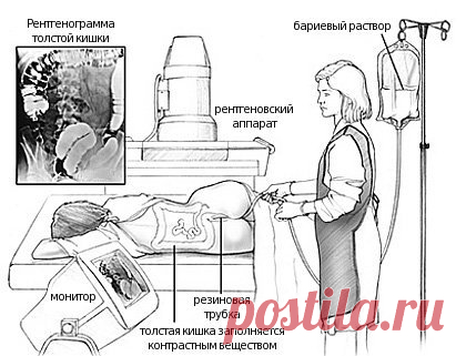 Ирригоскопия кишечника - что это такое? Подготовка, отзывы и цена ирригоскопии