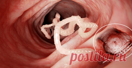 7 ранних признаков солитера, которые нельзя игнорировать