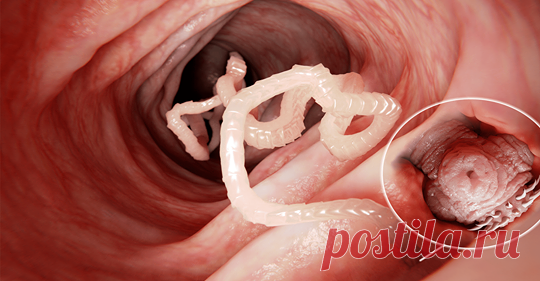 7 ранних признаков солитера, которые нельзя игнорировать