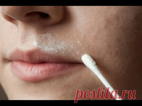 ЭФФЕКТИВНЫЙ ПРИРОДНЫЙ РЕЦЕПТ  УДАЛЕНИЯ  УСИКОВ НА ЛИЦЕ!
