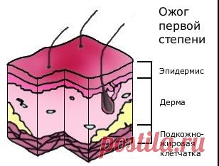 Клиника ожогов у детей.
По глубине повреждения различают 4 степени ожога.