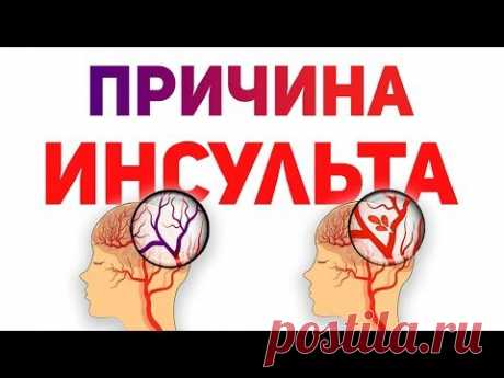 Причина инсульта. Инсульт мозга.