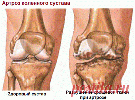 Это нужно знать!!! В чем разница между артрозом, артритом и остеопорозом? | Всегда в форме!
