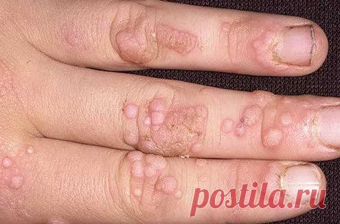 9 мощных рецептов, которые устранят бородавки навсегда всего за 1 неделю! / Будьте здоровы