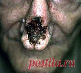 #Сифилис - описание и лечение болезни