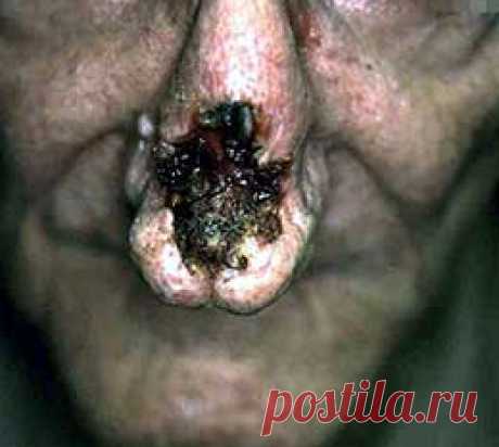 #Сифилис - описание и лечение болезни