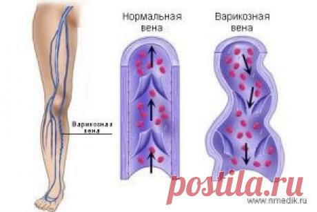 Варикозное расширение вен - народные средства - Варикозное расширение вен (варикоз).