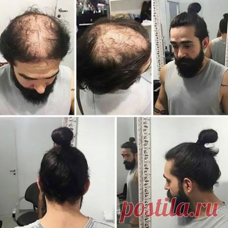 Как спрятать лысину