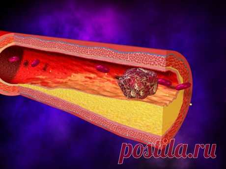 Какие продукты способствуют рассасыванию тромбов? | Между нами | Яндекс Дзен