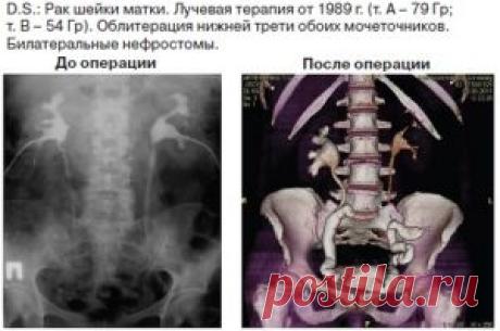 Злокачественные новообразования органов малого таза | РАК И МЕДИЦИНА