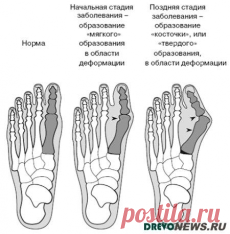 Вальгусная деформация. Народные средства. » VL-Club.com