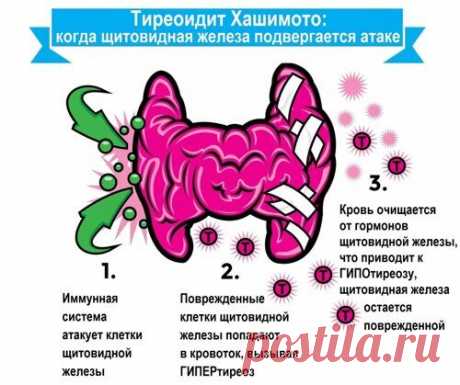 Тиреоидит Хашимото (АИТ) и функциональное питание с пробиотиками