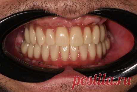 Не стремитесь к искусственным зубам - протезам. | Parodoctor | Дзен
