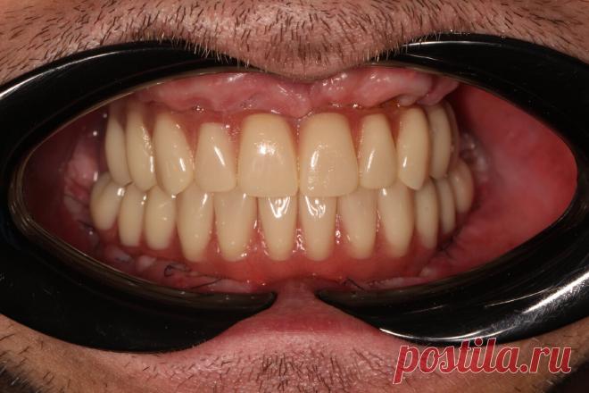 Не стремитесь к искусственным зубам - протезам. | Parodoctor | Дзен