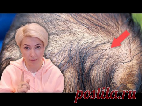 Выпадение волос | Как избавиться от выпадения волос в домашних условиях | Профилактика седины