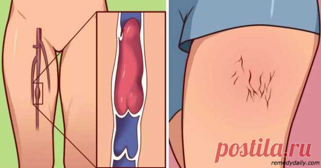 6 признаков, что у вас может быть тромб — Journal women❜s