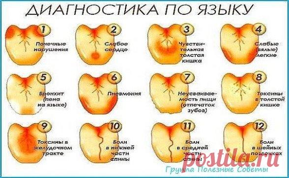 Сохраните, чтобы не потерять
СОВЕТ 1: Как по языку узнать о сбоях в работе позвоночника, желудка, печени и предотвратить их?
В медицине очень мало правил без исключений, но среди них есть одно такое правило: симптомы заболеваний проявляются на языке примерно за сутки–двое до того, как начинают болеть пораженные органы. 
Диагностику по языку следует проводить утром, натощак, при естественном дневном освещении и после предварительного ополаскивания ротовой полости.
При осмот...