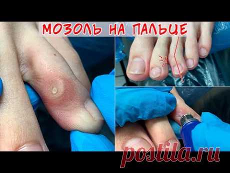 Удаление стержневой мозоли на ноге 🦶